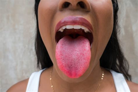 If Your Tongue Looks Like This You May Have Covid