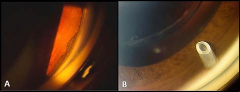 Preoperative Slit Lamp Imaging Showing Angle Recession Superiorly And A