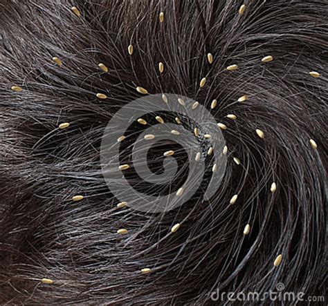 Head Lice Royalty Free Stock Photo - Image: 30974275