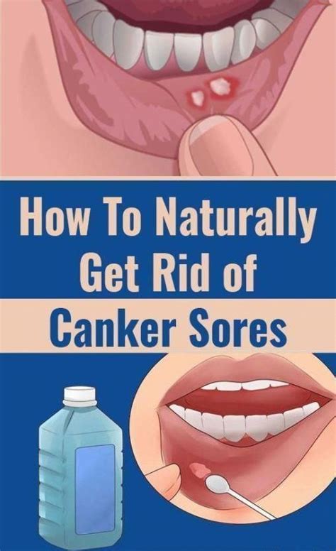 How To Cure Canker Sores And Mouth Sores Wellness Ways 0000