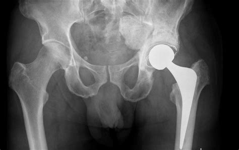 Right Total Hip Replacement Coggle Diagram Photos