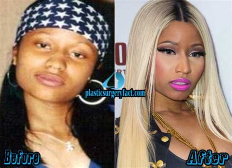 nicki minaj plastic surgery before and after photos plastic surgery facts