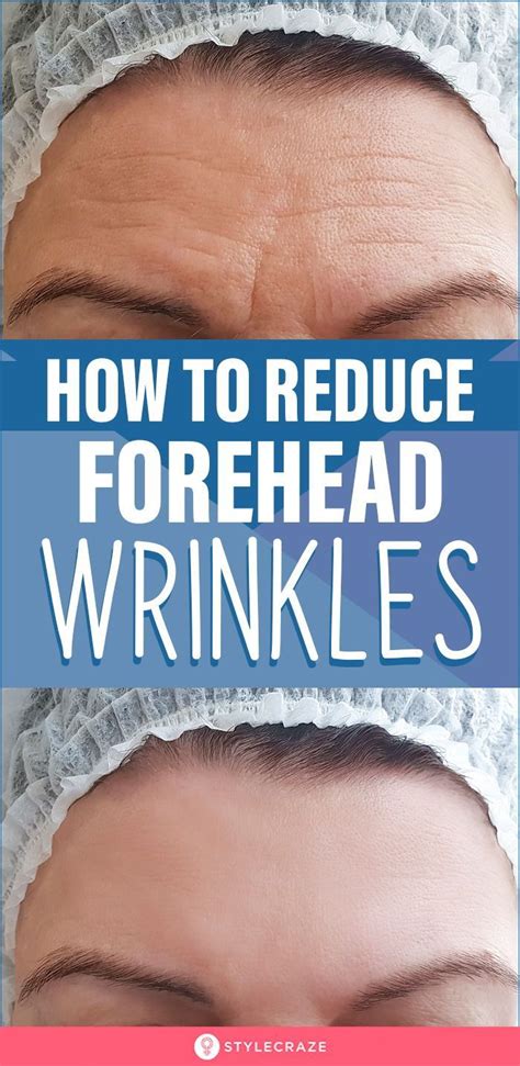 How To Get Rid Of Forehead Wrinkles 10 Home Remedies In 2021 Forehead Wrinkles Reduce