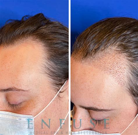 Gender Affirming Hair Restoration Chicago Hair Treatment Wicker Park