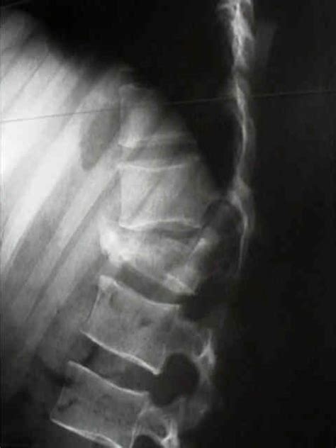 Radiology Of Burst Fractures Wheeless Textbook Of Orthopaedics