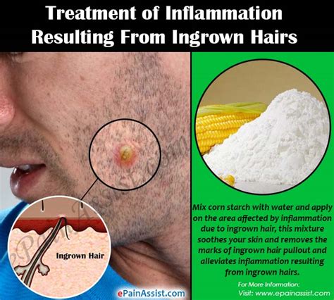 Treating Inflammation Resulting From Ingrown Hairseasy Ways To Get Rid