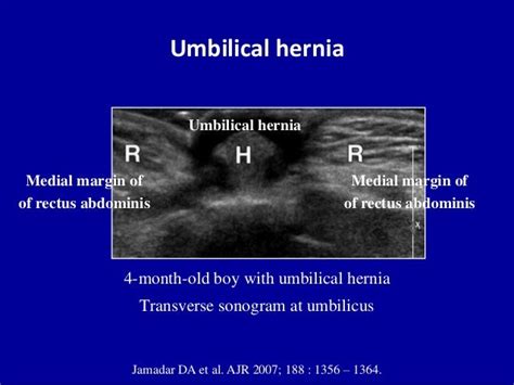 Abdominal Wall Hernia Ultrasound