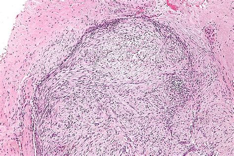 Nodular Fasciitis Libre Pathology