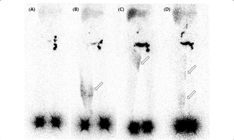 Representative Lymphoscintigraphic Images According To Dermal Backflow