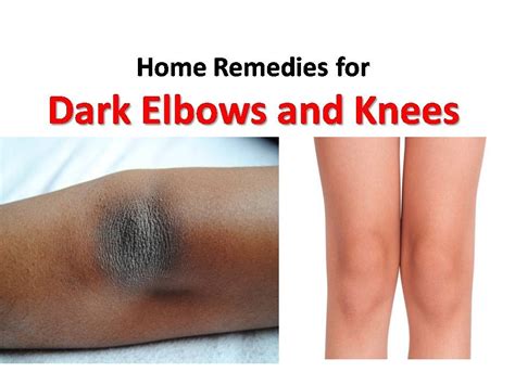 Home Remedies For Dark Elbows And Knees Get Rid Of Black Knees And