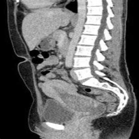 Delayed Miscarriage Inside An Infected Decidual Cast A Rare