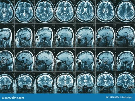 MRI Scan Or Magnetic Resonance Image Of The Brain Showed Obstructive