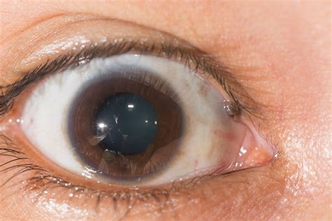 Eye Freckles Causes Types And Treatment