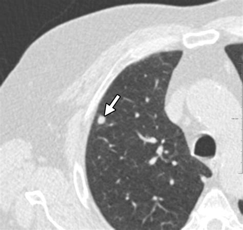 Classification Of Ct Pulmonary Opacities As Perifissural Nodules