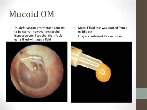 Medical Imaging Otitis Media And Otosclerosis