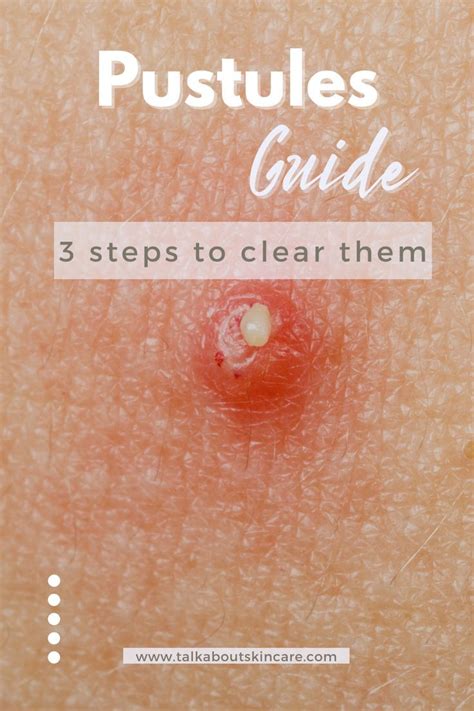 What Are Pustules And 3 Steps On How To Clear Them In 2022 Types Of