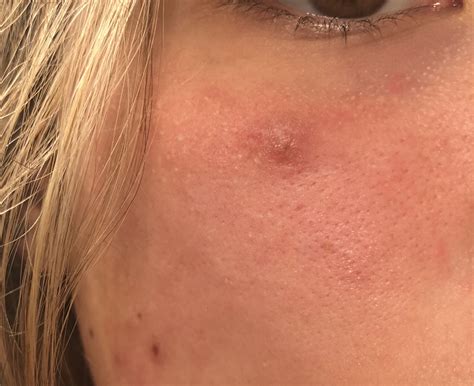 Mysterious Bump Under Eye Help — Its Been A Month General Acne