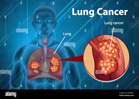 Informative Illustration Of Lung Cancer Stock Vector Image And Art Alamy