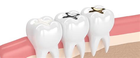 • patients have a history of allergy to mercury or other amalgam components. Are Amalgam Dental Fillings Toxic? - Renken Dentistry