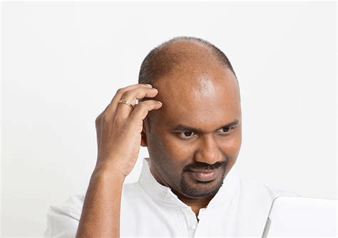 Unlocking The Mystery Exploring Catchy Hair Loss Causes For Men And
