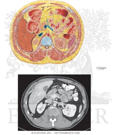 Cross Section At T12 L1 With Ct