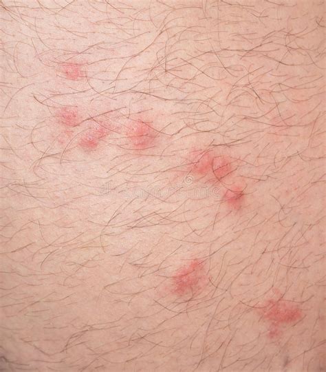Flea Bites Over Caucasian Man Hairy Skin Stock Photo Image 45511358
