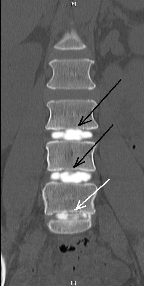 Lumbar Discograms Lower Back Pain Diagnosis