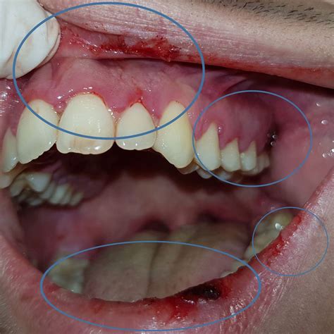 Herpetic Lesions Mouth