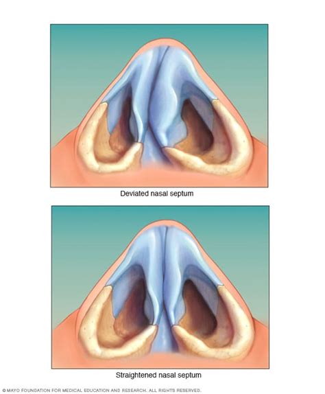 Fractura Nasal Síntomas Complicaciones Y Tratamientos Todo En La Red
