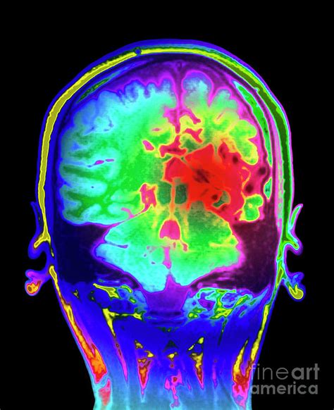 Colour Mri Brain Scan Of Arteriovenous Malfunction Photograph By Simon