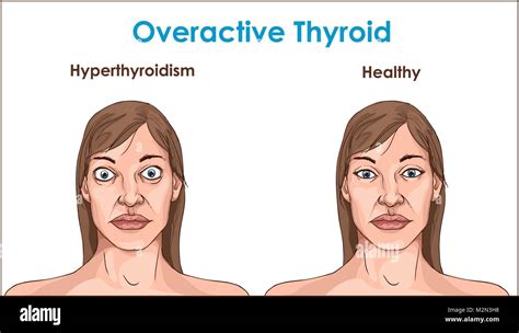 Hypothyroidism Face Swelling