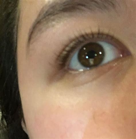 What Is This Natural Dark Spot On The Outer Corner Of The Eye Called