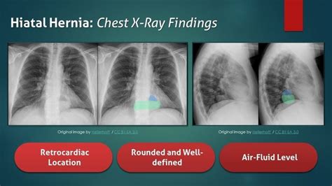 Hiatal Hernia Chest X Ray Findings X Ray Nursing School Survival
