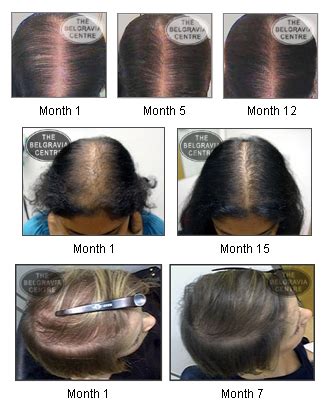 The good news is that with lifestyle changes to reduce stress, dietary improvements and the use of other natural hair loss remedies you can improve hair growth fast. Female Hair Loss Treatments