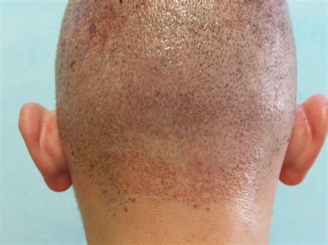 Los Angeles FUE Hair Transplant Follicular Unit Extraction Using The