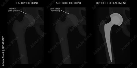 Vector Illustration X Ray Of Human Pelvis Healthy Hip Arthritic Hip