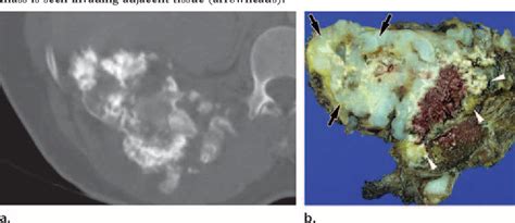 Figure 1 From Imaging Of Primary Chest Wall Tumors With Radiologic