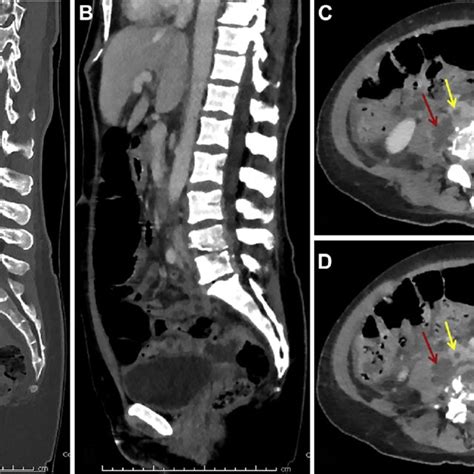 E Sagittal Ct Images From Abdominal Pelvis Ct In Bone A And