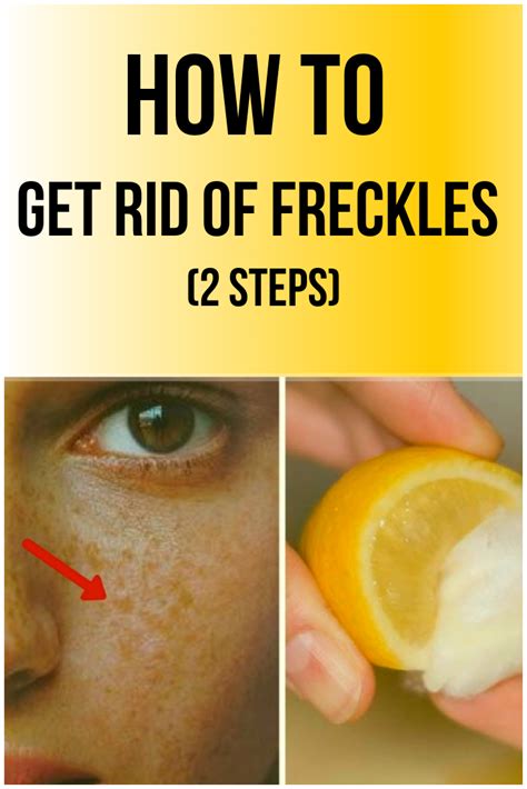 How To Get Rid Of Freckles 2 Steps How To Get Rid Freckles Health