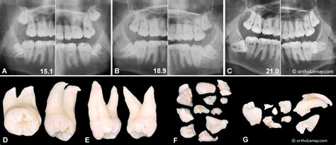 Wisdom Teeth Third Molars Myths And Realities Orthodontiste