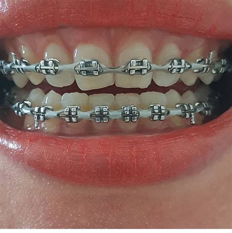 Pin By Elpotrillo31 On Mouth Braces Braces Colors Teeth Braces