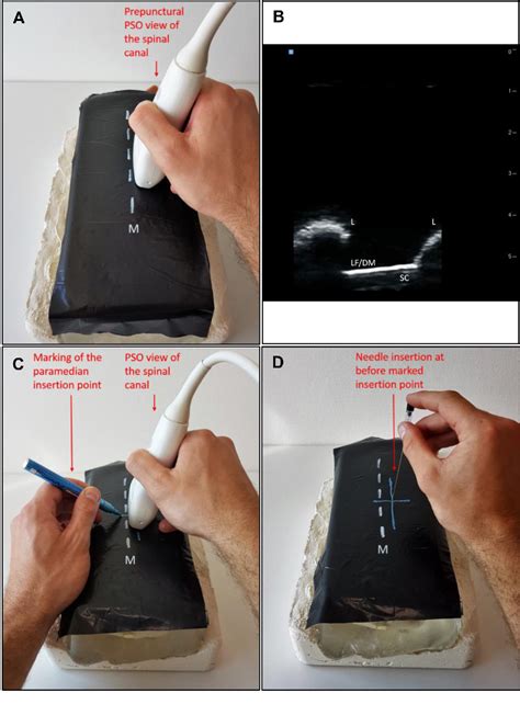 Figure 1 From Ultrasound Guided Lumbar Puncture With A Needle Guidance
