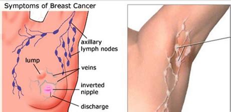 How common is breast cancer? 5 WARNING SIGNS OF BREAST CANCER THAT MANY WOMEN IGNORE ...