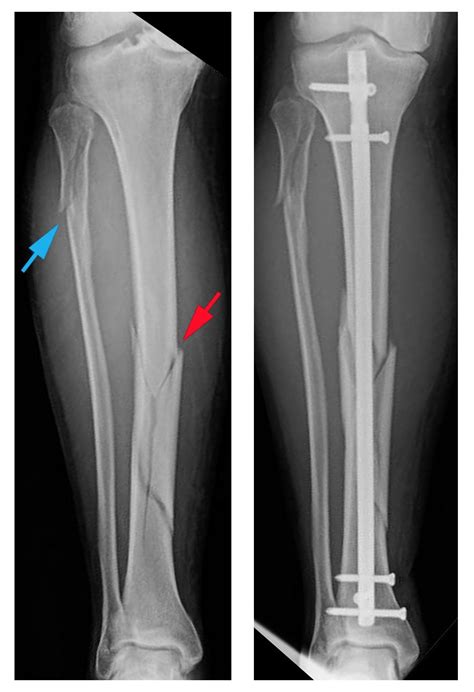 In rare cases, external fixation or orif is more appropriate radiographs of the tibia and fibula are provide in figures a and b. ️ Broken tibia and fibula healing time. What Is the ...