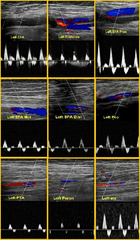 Doppler Ultrasound Of Lower Limb Arteries Sexiz Pix