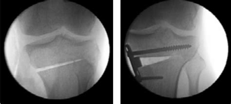High Tibial Osteotomy Sydney Knee Surgeon