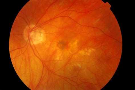 Colour Fundus Photo Of The Left Eye With Myopic Macular Degeneration