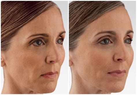 JuvÉderm Voluma Xc Before And After Altaire Clinic