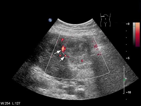 Contrast Enhanced Gray Scale Harmonic Ultrasound And Ct Scan Of A