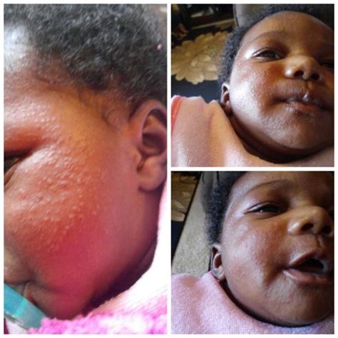 Young kids, as they become more mobile, get it in. eczema in African American babies - BabyCenter